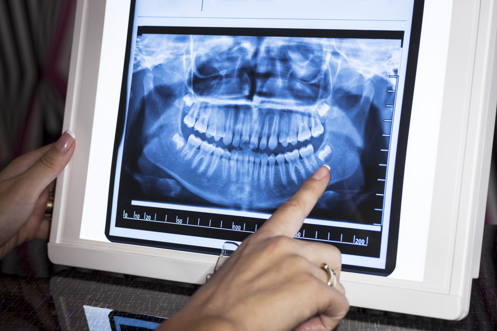 Ein Röntgen-Bild der Zahnpartie