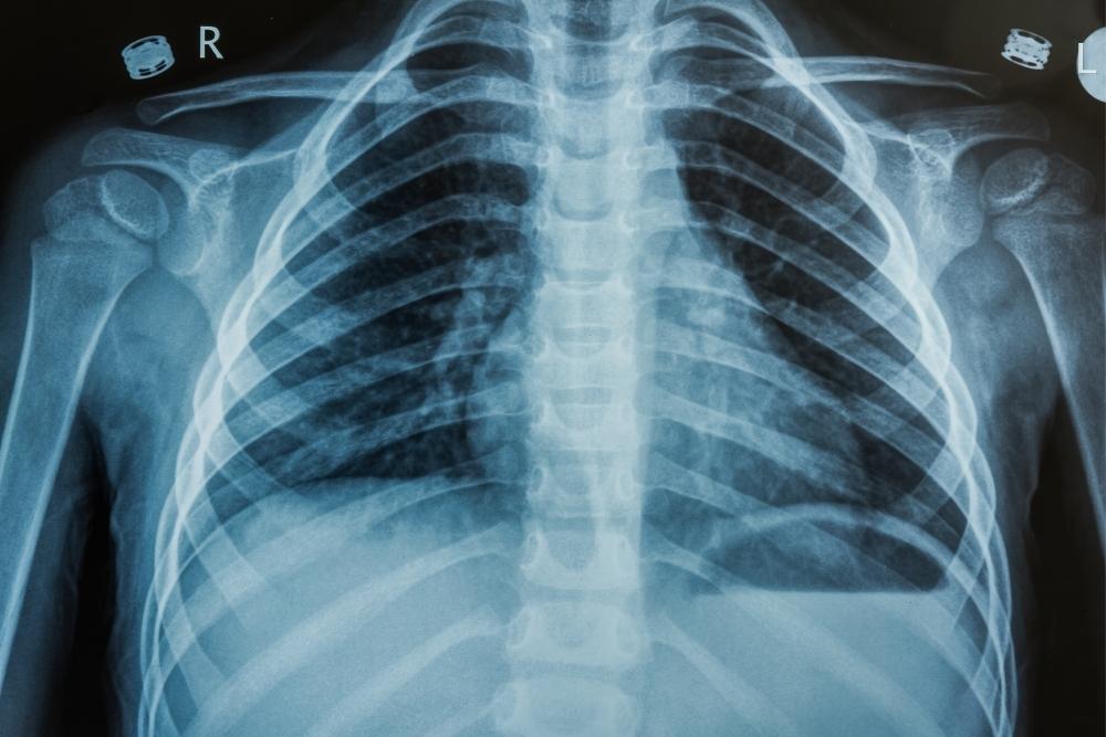 Röntgen-Thoraxaufnahme (Brustkorb)