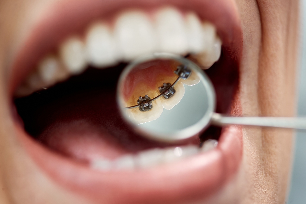 Kieferorthopäde mit Mundspiegel untersucht Lingual-Zahnspange bei Patientin