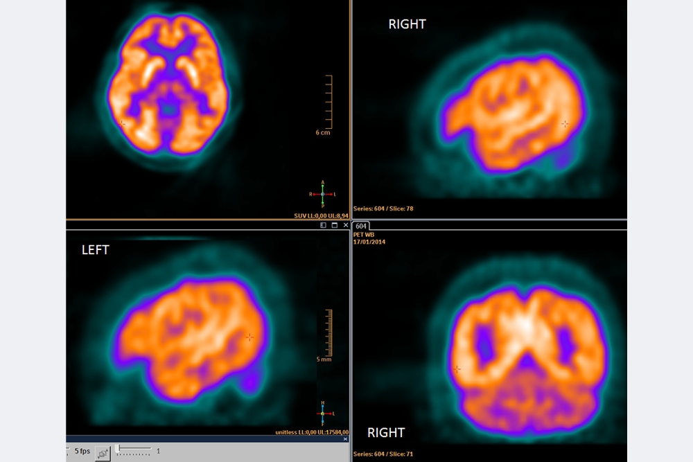 Ein PET-CT-Bild von einem Gehirn.