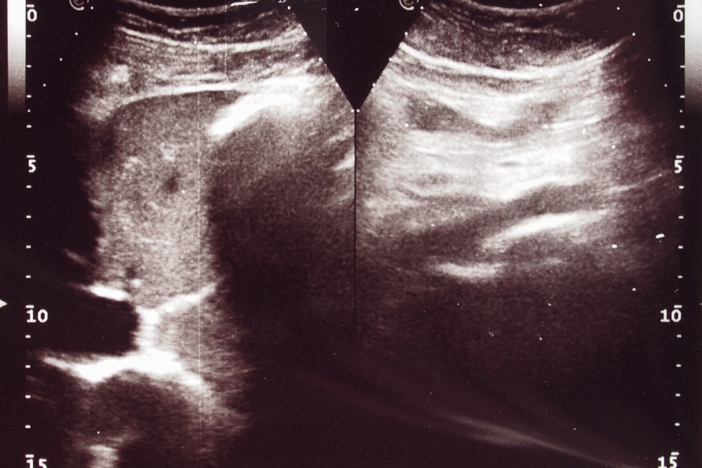 Abdomen-Ultraschallbild