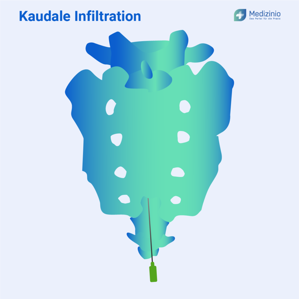 Die kaudale Infiltration der Wirbelsäule.