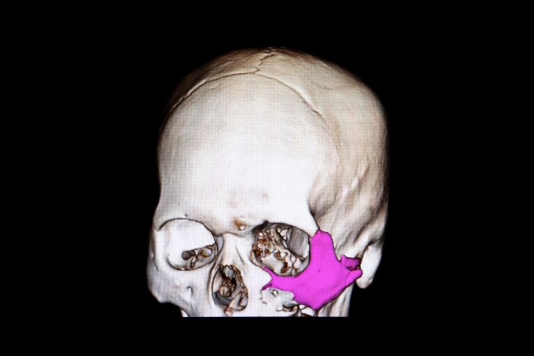 Ein Schädel-CT Bild