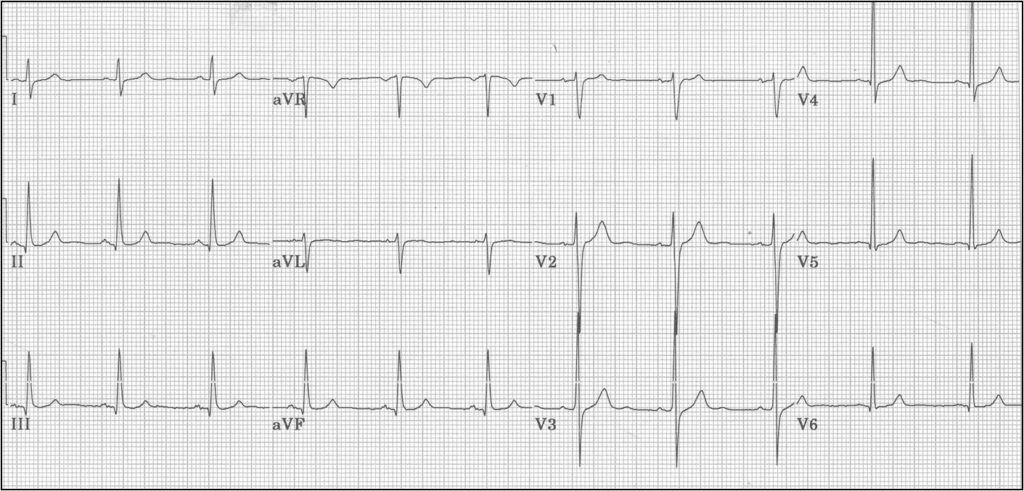 Ein normales 12 Kanal EKG.