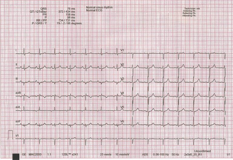 Ein normales 12 Kanal EKG.