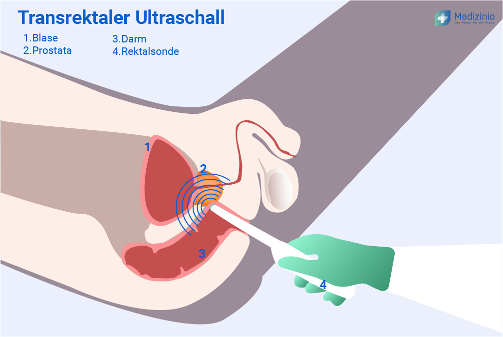 Transrektaler Ultraschall (TRUS)