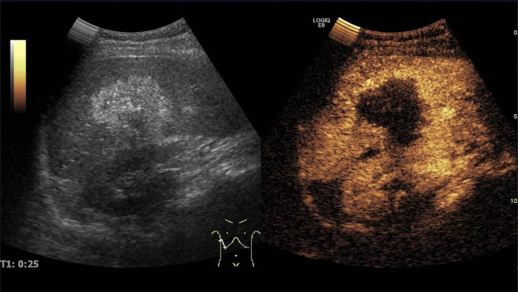 Ein Kontrastmittelsonographie-Ultraschallbild der Leber.