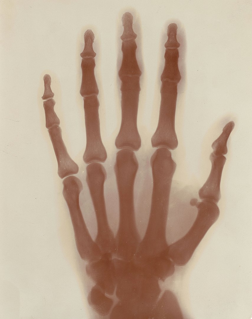 Röntgenbild der linken Hand von Nikola Tesla.