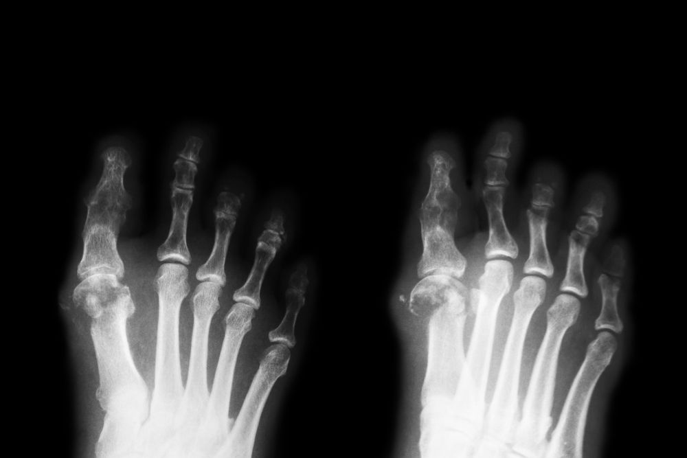 Röntgenbild diabetischer Fuß