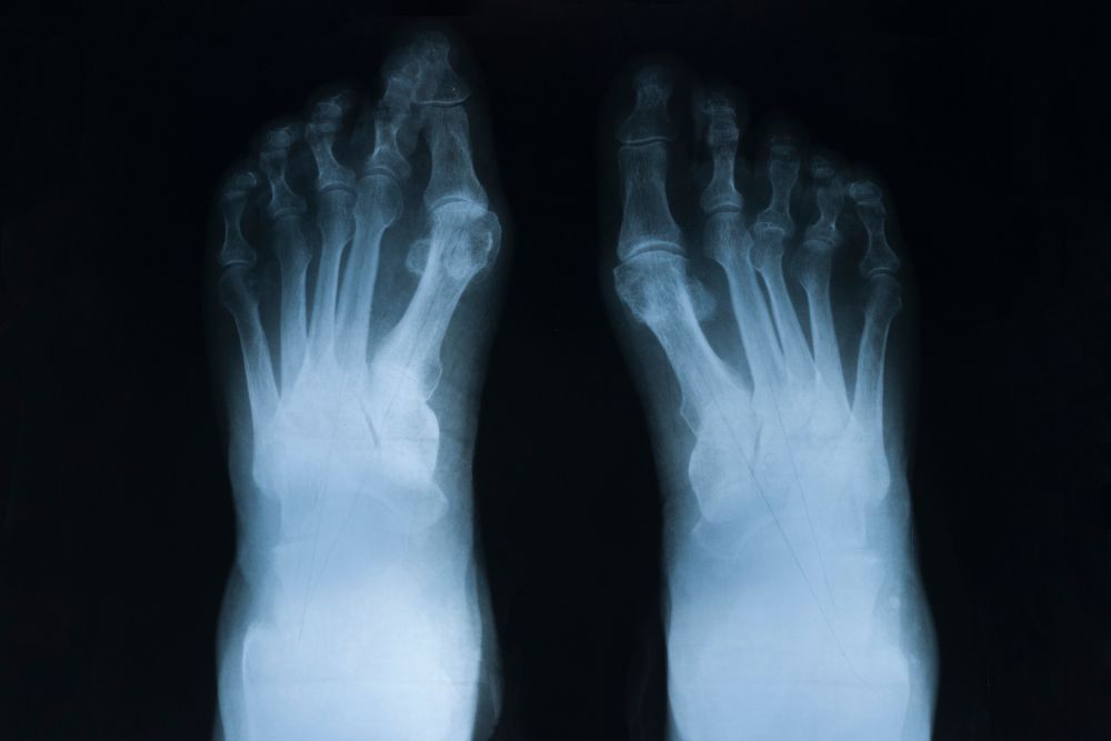 Röntgenbild von Füßen mit rheumatoider Arthritis