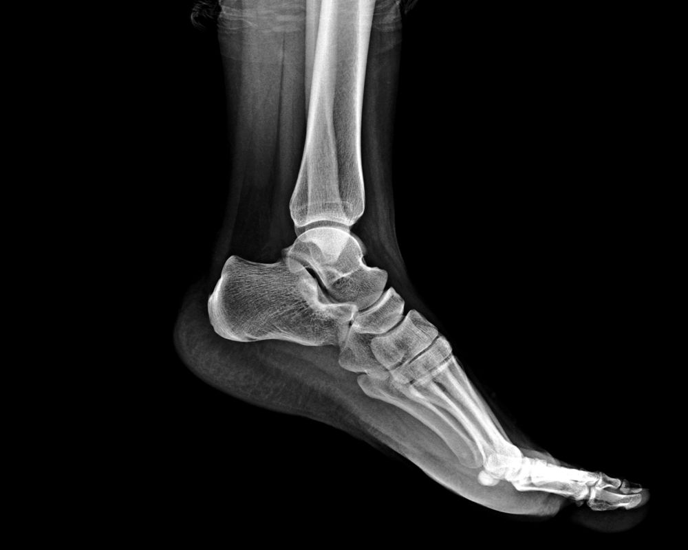 Röntgenbild Fuß gesund/Normalbefund links lateral (seitlich)
