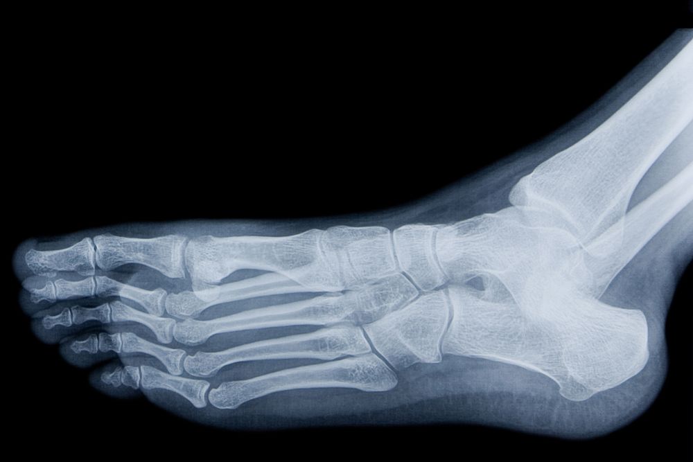 Röntgenbild Fuß links