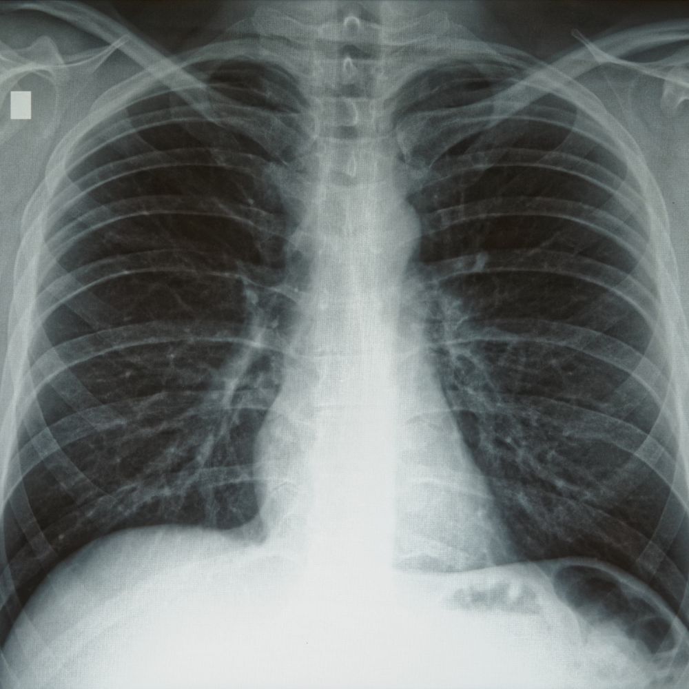 Röntgen-Thoraxaufnahme einer gesunden Lunge.