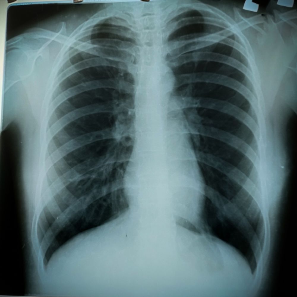 Röntgenaufnahme der Lunge eines Patienten mit chronisch obstruktiver Lungenerkrankung (COPD)