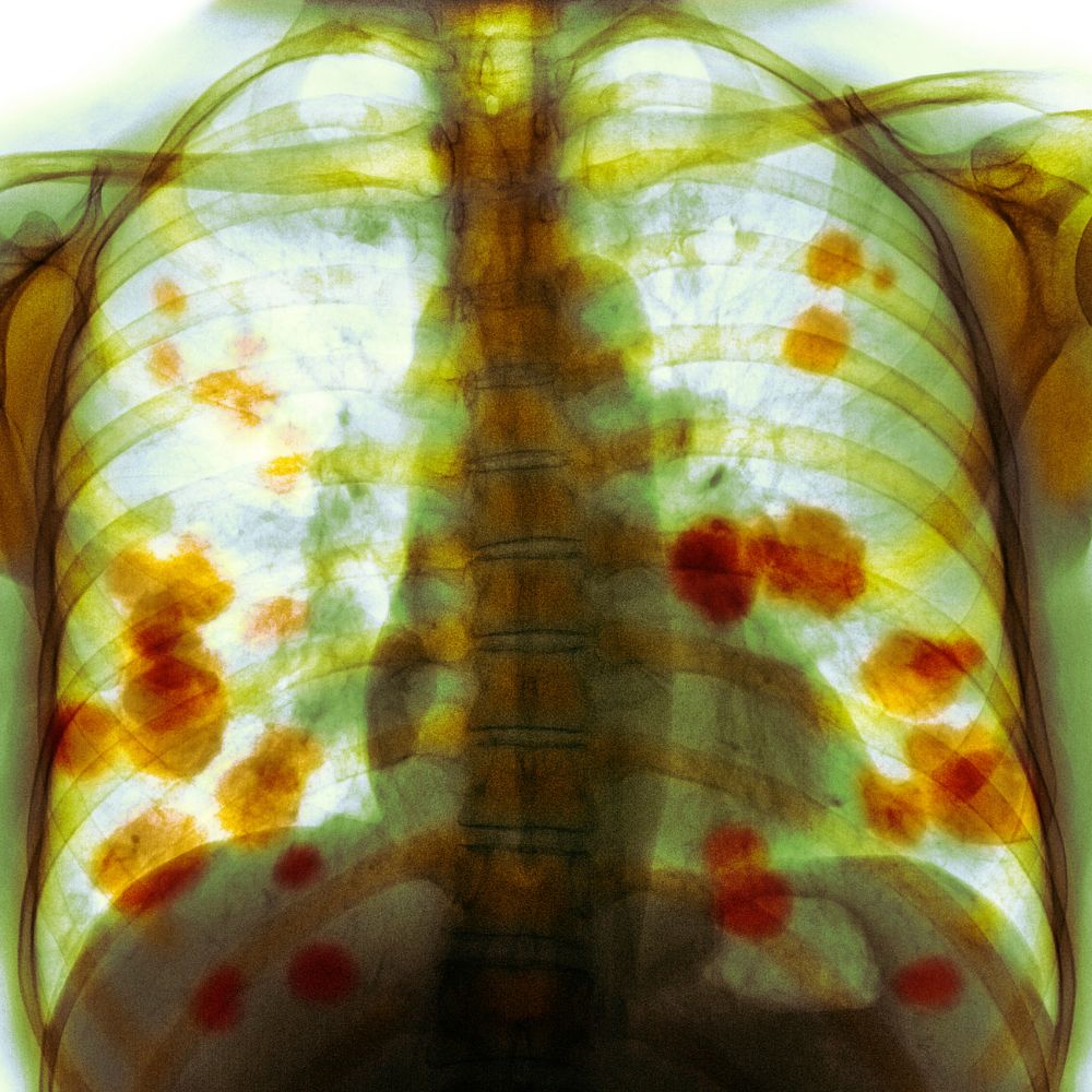 Farbiges Röntgen-Thoraxaufnahme einer 52-jährigen Patientin mit metastasiertem (sekundärem) Lungenkrebs.