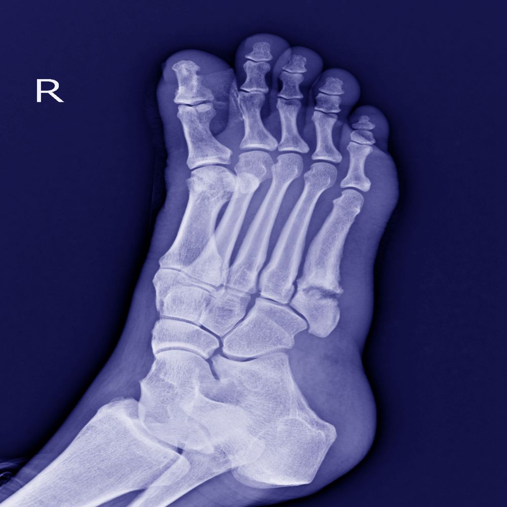 Röntgenbild eines gebrochenen rechten Mittelfußknochens (Basisfraktur, 5. Os metatarsales).