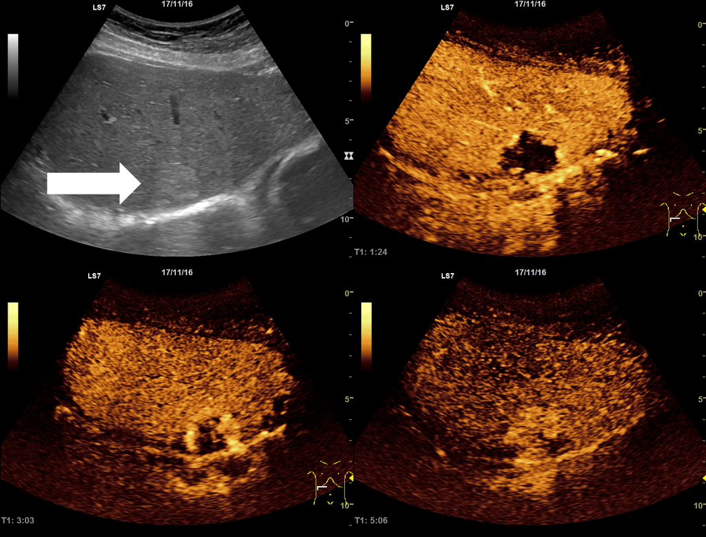 Ultraschallbilder eines Leberhämangioms im B-Bild und nach Gabe von Kontrastmittel (CEUS-Ultraschall).