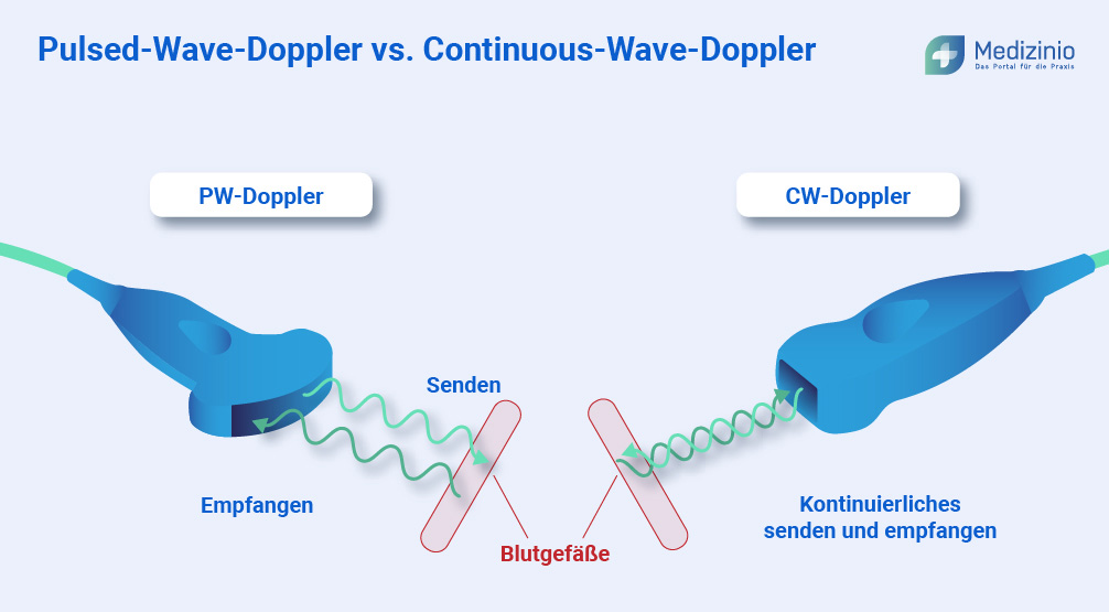 Unterschied zwischen PW-Doppler und CW-Doppler.