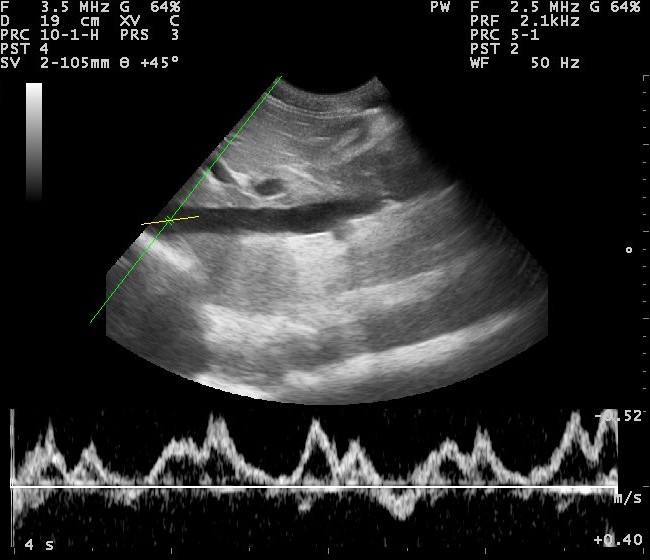 PW-Doppler-Ultraschallbild der Vena cava inferior (untere Hohlvene) in schwarz-weiß