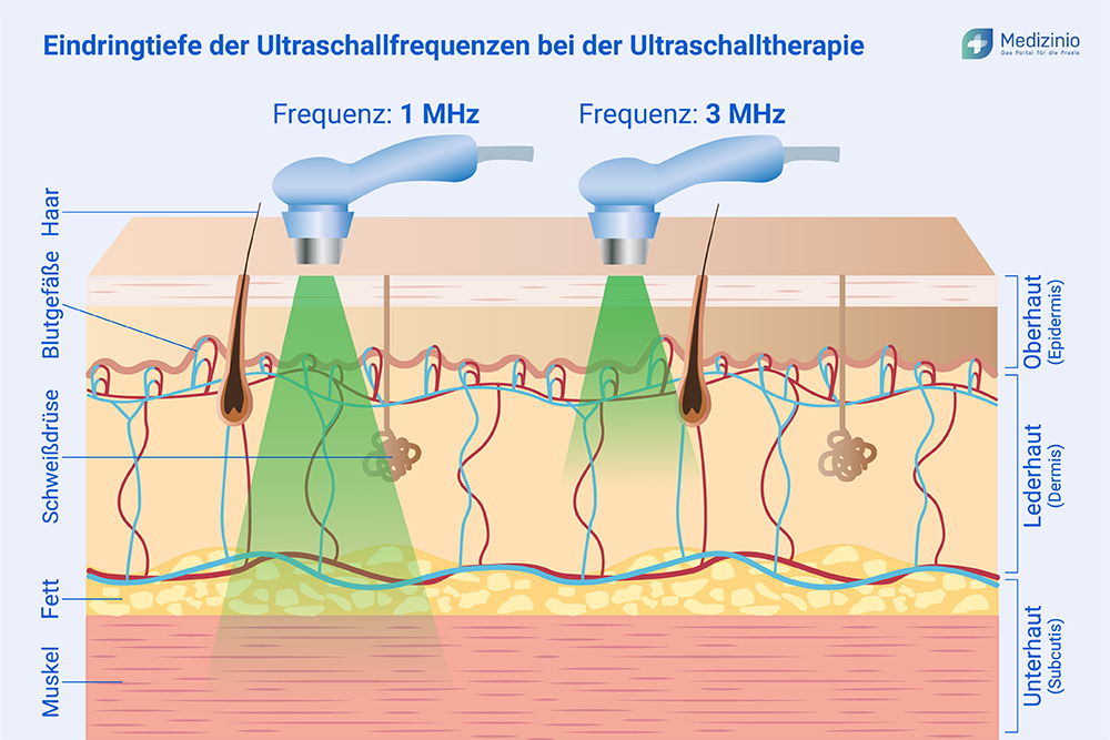 Eindringtiefe der Ultraschallfrequenzen bei der Ultraschalltherapie (1 MHz und 3MHz).