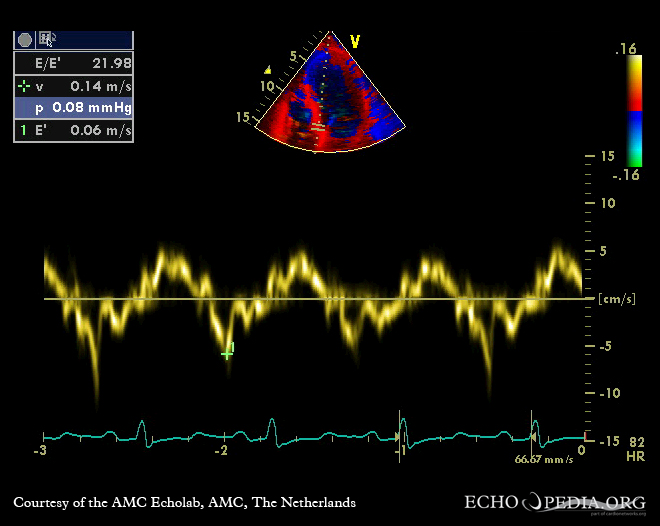 Gewebedoppler-Ultraschallbild: Hypertrophe Kardiomyopathie, diastolische Dysfunktion