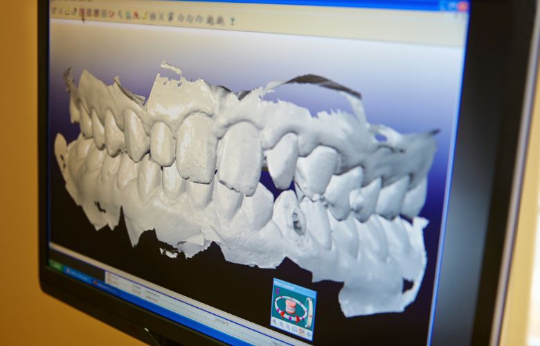Digitale 3D-Darstellung eines Kiefers und der Zähne auf einem Monitor als Ergebnis eines Intraoralscans.